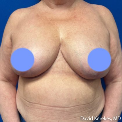 Breast Asymmetry Before & After Patient #5229