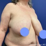 Breast Asymmetry Before & After Patient #5229