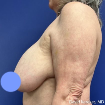 Breast Asymmetry Before & After Patient #5229