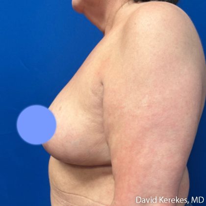 Breast Asymmetry Before & After Patient #5229