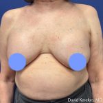 Cosmetic Breast Revisions Before & After Patient #5237