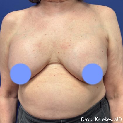 Cosmetic Breast Revisions Before & After Patient #5237