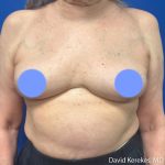 Cosmetic Breast Revisions Before & After Patient #5237