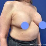 Cosmetic Breast Revisions Before & After Patient #5237