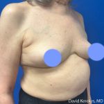 Cosmetic Breast Revisions Before & After Patient #5237