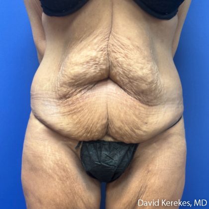 Tummy Tuck Before & After Patient #5255