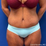 Tummy Tuck Before & After Patient #5255