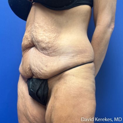 Tummy Tuck Before & After Patient #5255