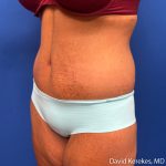 Tummy Tuck Before & After Patient #5255