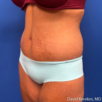 Tummy Tuck Before & After Patient #5255