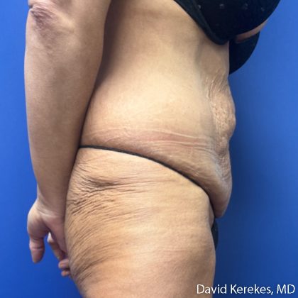 Tummy Tuck Before & After Patient #5255