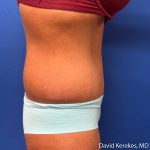 Tummy Tuck Before & After Patient #5255