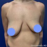 Breast Lift with Implants Before & After Patient #5262