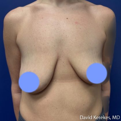 Breast Lift with Implants Before & After Patient #5262