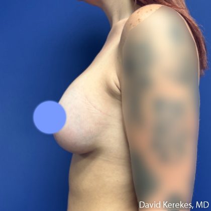 Breast Lift with Implants Before & After Patient #5262