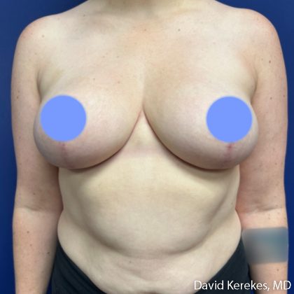 Breast Reduction Before & After Patient #5270