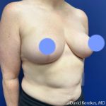 Breast Reduction Before & After Patient #5270