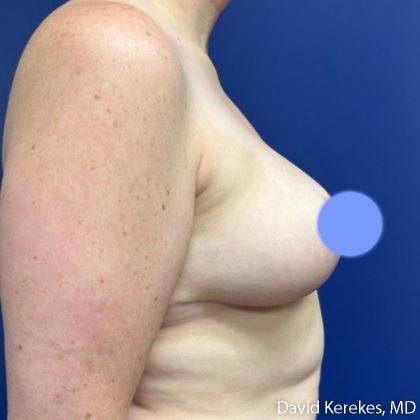 Breast Reduction Before & After Patient #5270
